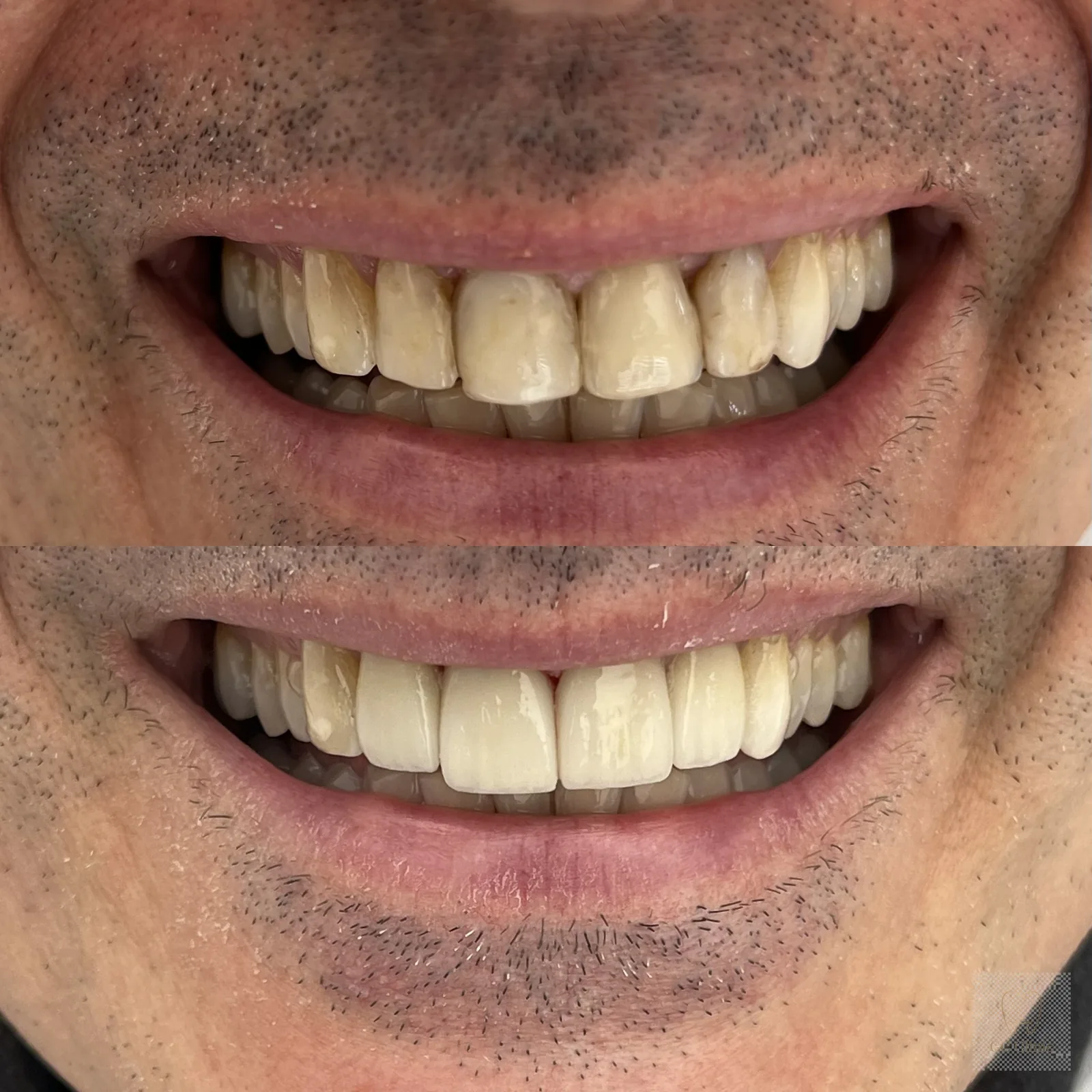 Minimalinvasive Veneer-Behandlung — Vorher/Nachher, GC Clinic Istanbul