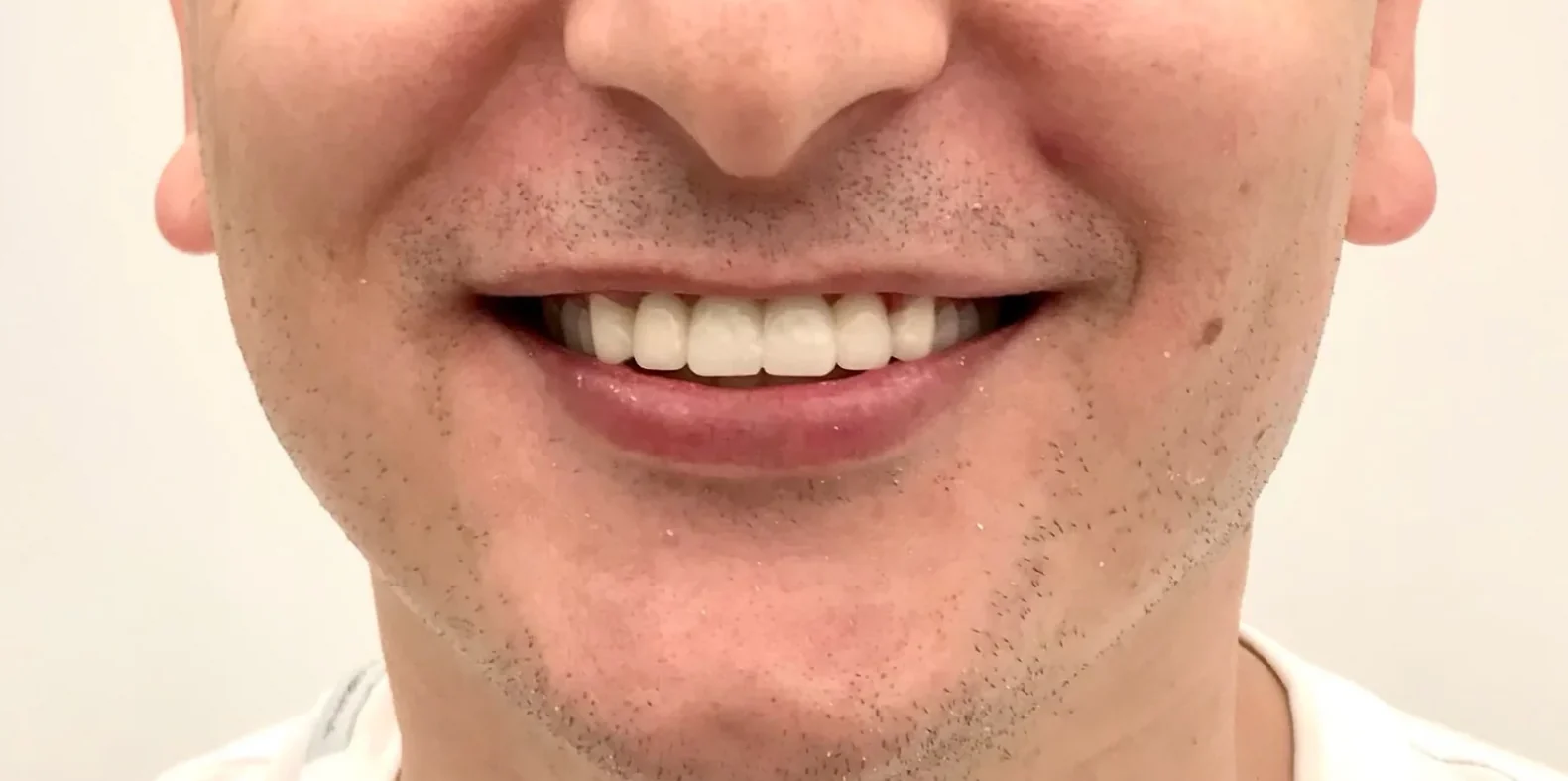 Nachher